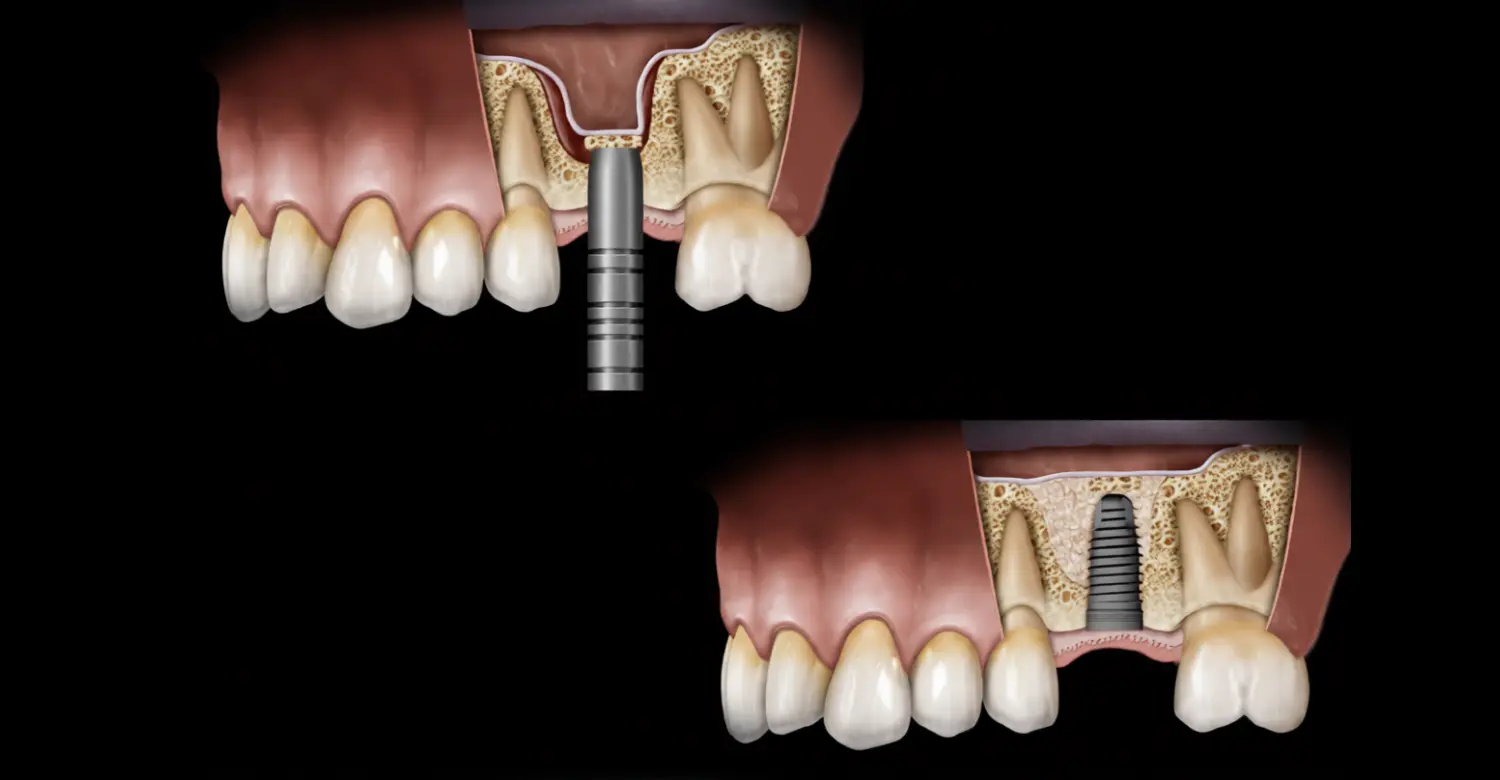 Sinus Lift Surgery Before Dental Implants Explained 2